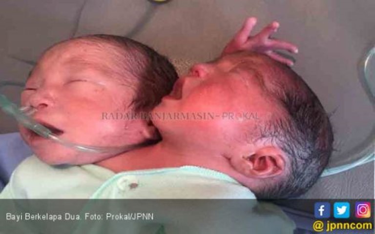 Bayi Berkepala Dua Lahir di Kalimantan Selatan