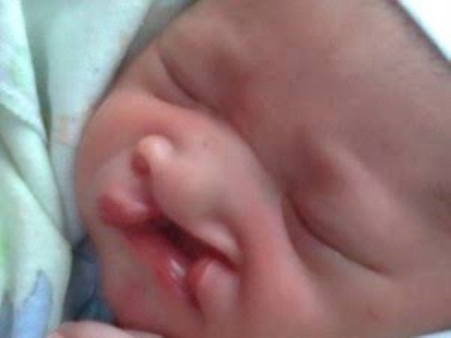 Inilah Penyebab Bayi Lahir dengan Bibir Sumbing