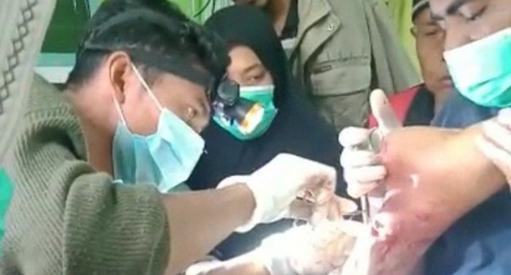 Dililit dan Digigit Piton Besar, Meri Selamat dengan Kaki Luka Parah