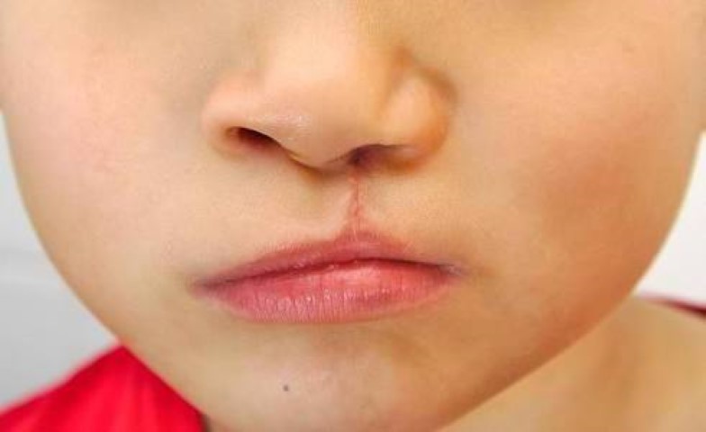 8 Faktor Risiko Penyebab Bibir Sumbing