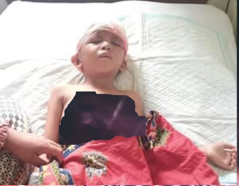 Rambut Bocah 6 Tahun Asal Mandah Inhil Terlilit As Pompong, Bupati Tanggung Pengobatan 