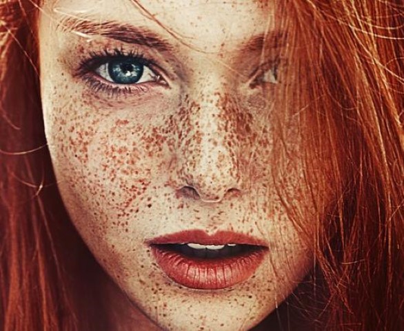 Mitos dan Fakta tentang Freckles